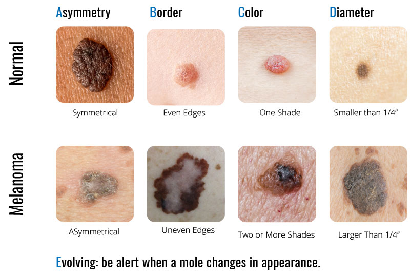 images of cancerous skin tags