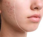 acne-treatment