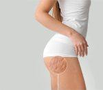 cellulite-treatment